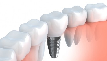 Dental Implants