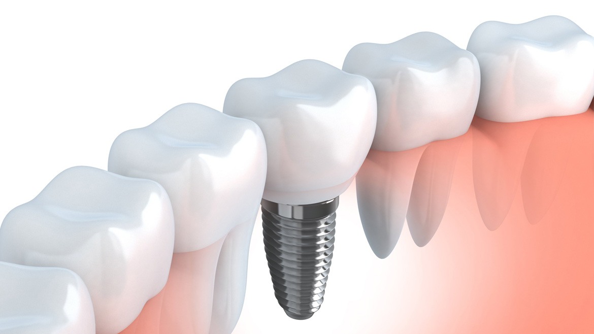 Dental Implants