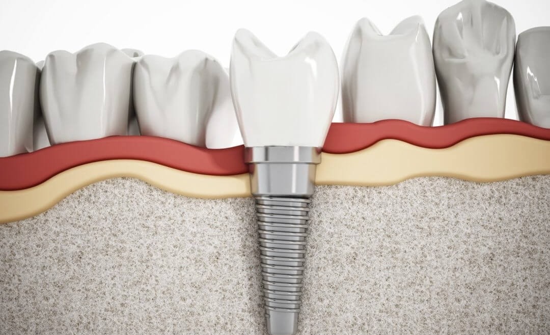 Dental Implants: What to Expect