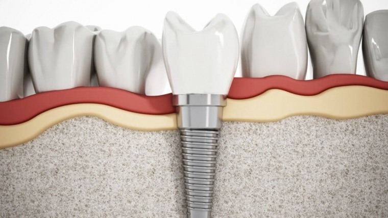 Dental Implants: What to Expect